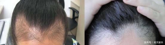 体重|产后“秃”如其来,体重突飞猛进过来人教你几招,保证有效