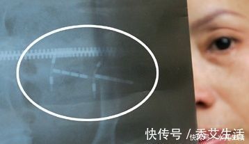 宝妈|宝妈为了生二胎,决定去医院取出节育环,但没到会变成“利器”
