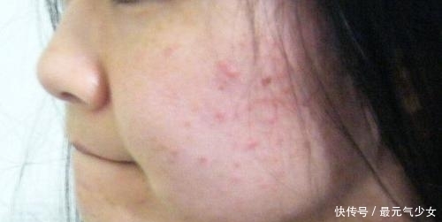 湿气重不重，脸不会骗人，脸上出现“这东西”，快学3招除湿气