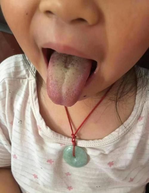 扁桃体发炎化脓能挤吗 扁桃体发炎化脓能挤吗