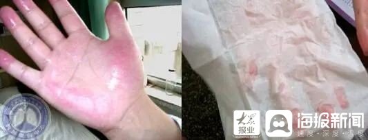 微创|山东大学齐鲁医院(青岛)胸外科微创手术助多例“手汗症”患者摆脱烦恼