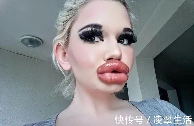 sofia 21次丰唇手术之后,这个妹子的嘴唇现在长这样…