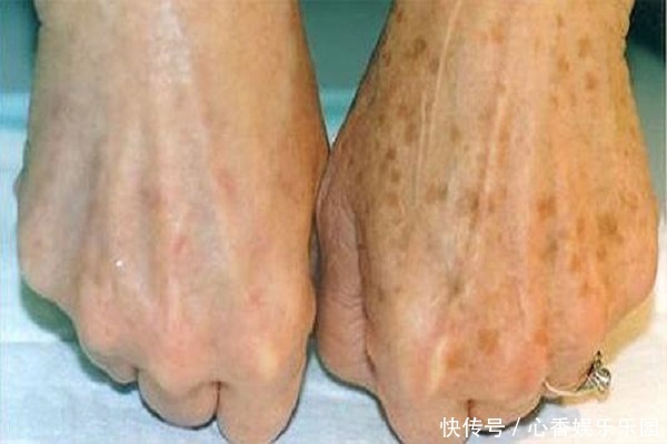 今年65岁了,脸上没有老年斑,她是如何做到的保养秘诀是什么