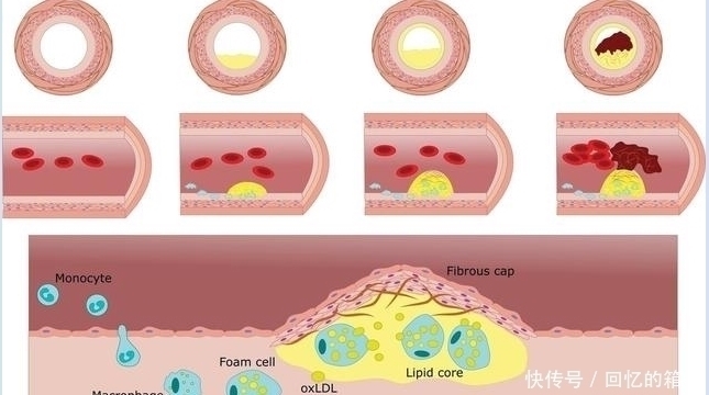 血脂|甘油三酯大于17很简单,1种粗粮煮水喝,血脂轻松降