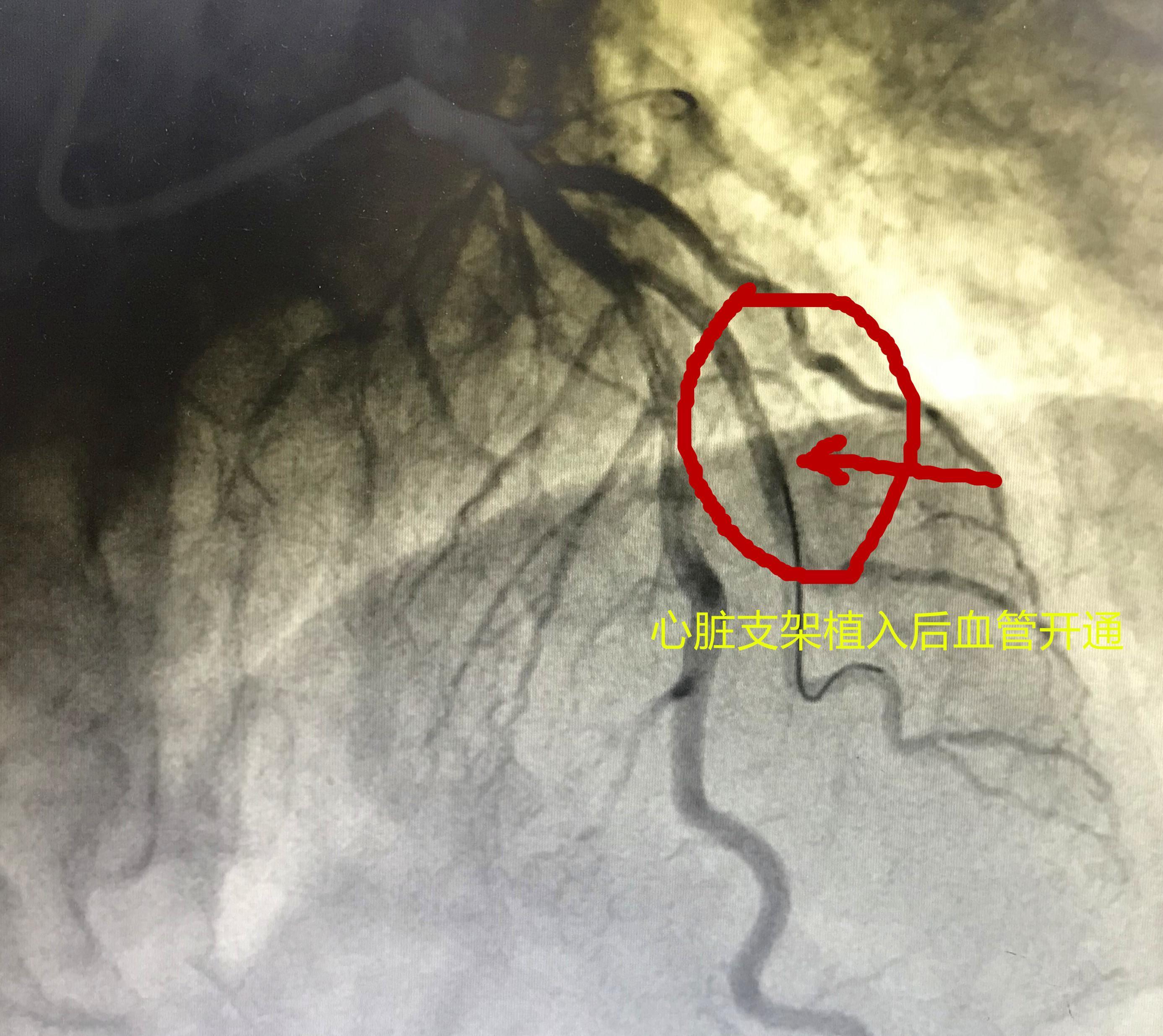 77岁老人反复心绞痛，吃饭的时候都发作，支架治疗后，结果怎样了