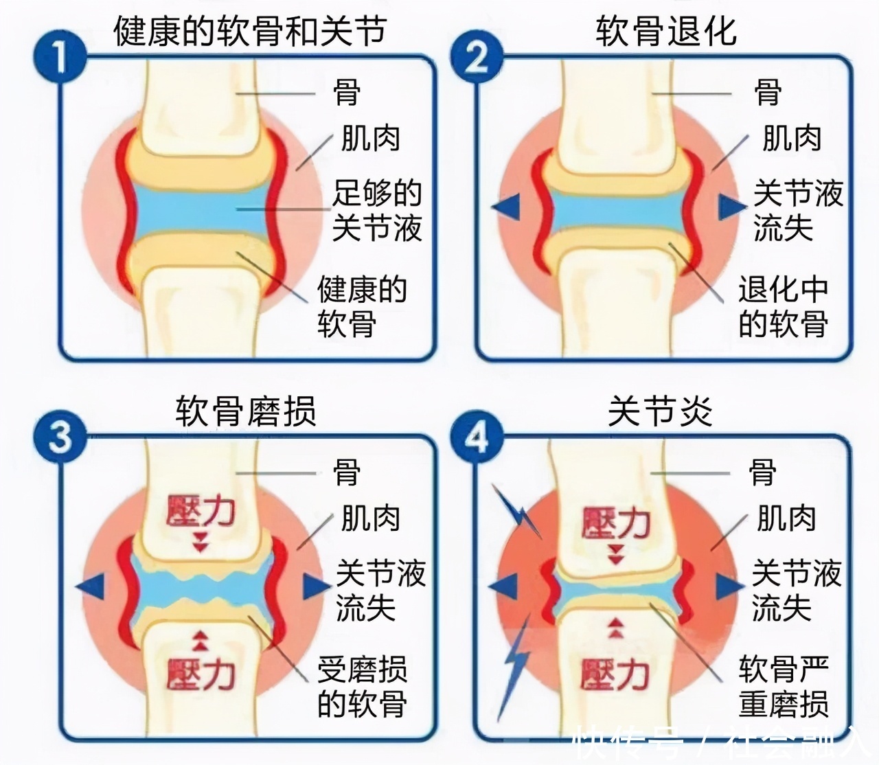 中老年人常受骨关节炎困扰，如何阶梯治疗减轻疼痛避免畸形