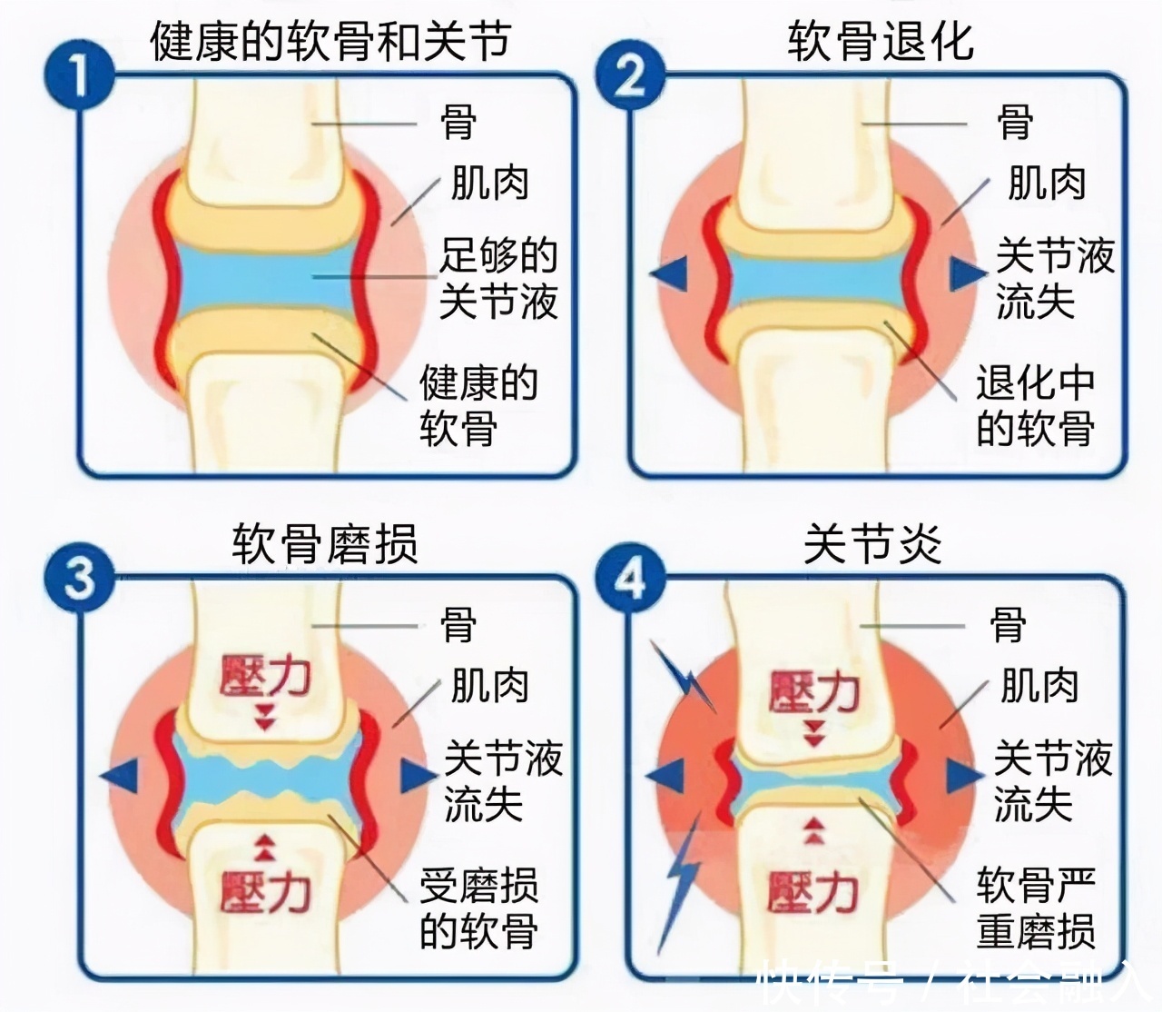 中老年人常受骨关节炎困扰,如何阶梯治疗减轻疼痛避免畸形