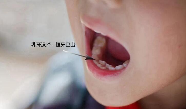 恒牙|最全儿童换牙时间表:儿童换牙何时开始、何时结束?一图说清