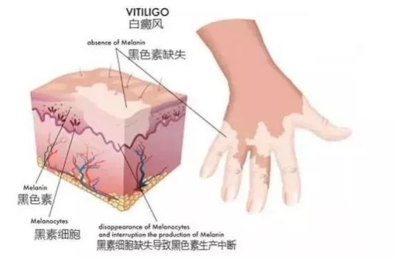 贫血痣|知道是白癜风不就行了，为什么还要做系统的诱因检查？合肥华夏阙光星主任为您解答