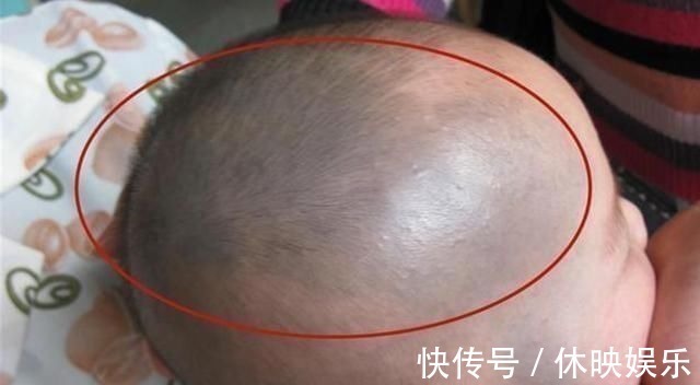 皮肤病|发现新生儿小屁屁上有“淤青”,老公想找护士理论,最后暗暗庆幸
