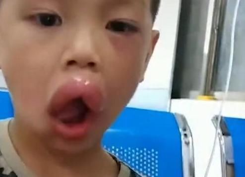 宝爸|熊孩子偷吃了一颗葡萄，嘴巴变成了香肠嘴，医生看了都憋笑