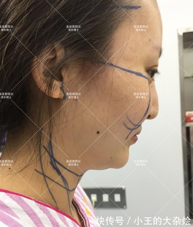 面部 做过3次线雕的她,为什么还要跑来做拉皮手术!