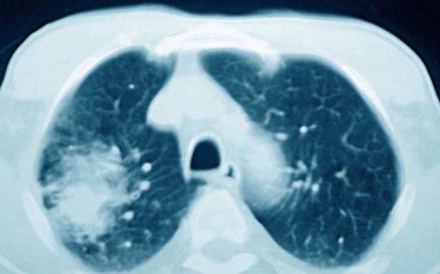肺癌|肺癌治疗已进入精准治疗时代,治疗新方法可能将肺癌变为慢性病