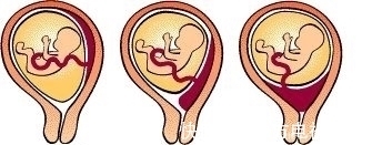 建档|生孩子是去人民医院好,还是去妇幼保健院好呢?得看孕妇的情况定