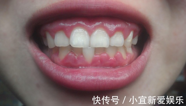 身体|嘴上长泡是身体在排毒吗?或许是暗示了这几个问题,别忽视