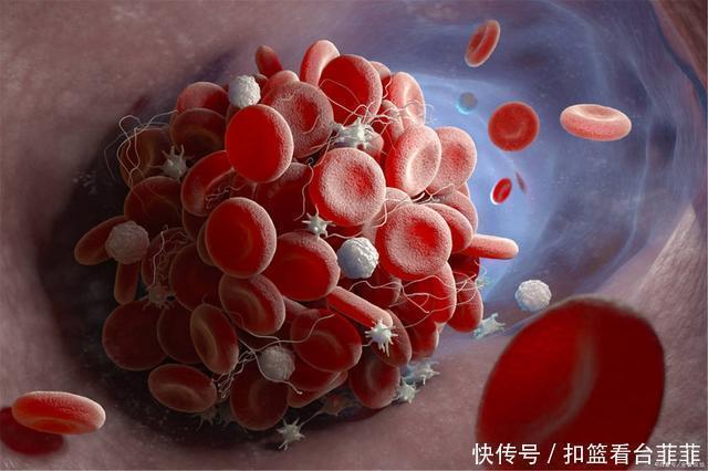 心血管主任:血脂高的人,坚持3件事,血脂变化,血栓无影踪