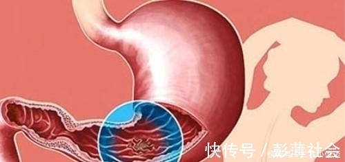 桑葚|得了慢性胃炎怎么办 医生 每天多吃这4种食物, 养胃消炎杀菌!