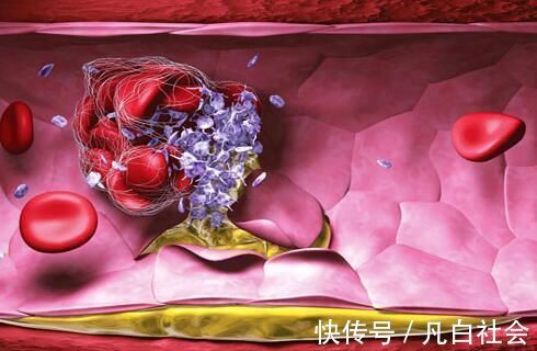 血管堵塞|体内出现血栓时，身体会有这4个表现，及时察觉或许能救你一命！