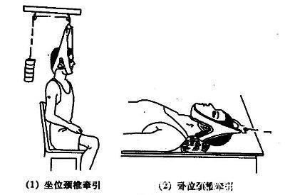 颈椎病|如何摆脱颈椎病疼痛？颈椎病的综合康复治疗，你需要知道！