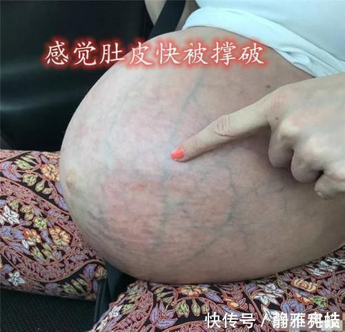 腹直肌|宝妈生完3胞胎后,肚皮严重下坠“收不回来”,网友心疼又害怕