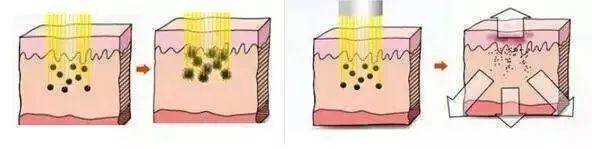 反黑 做完光子嫩肤之后反黑了怎么办呐?什么是反黑?术后该如何护理?