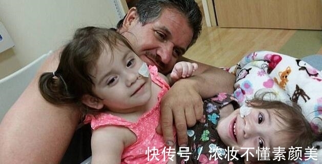 双胞胎|连体双胞胎做分离手术成功,每人分得一条腿,父母喜极而泣!