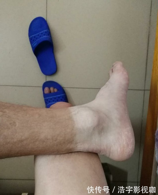 马路天使|男子晒“渐变色”皮肤,网友不服,一场“比惨”大赛开始了