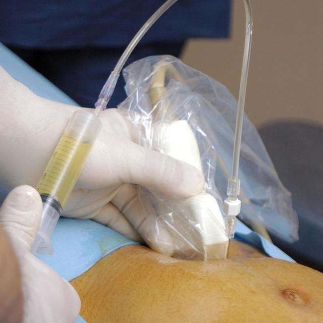 羊水穿刺|准妈妈做“羊水穿刺”现场,老公默默的喊加油,而妈妈已哭成泪人