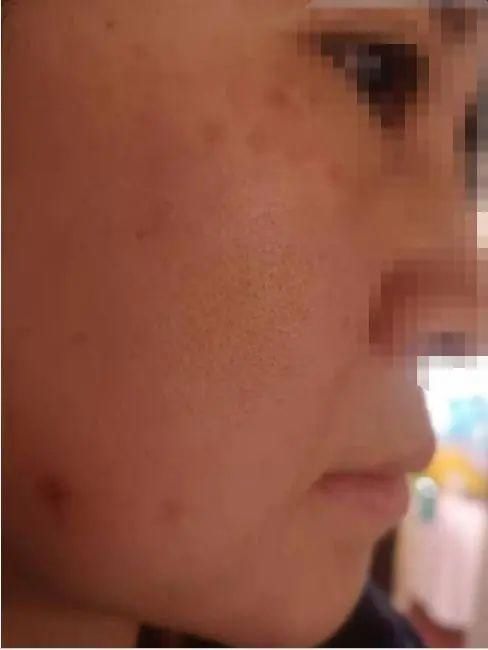 “热玛吉”到底有多热？烫伤起泡还留斑！