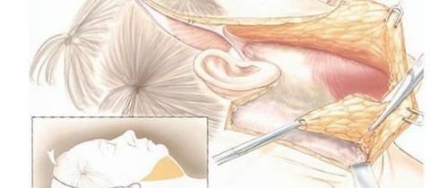 做拉皮要多少钱？先来了解一下