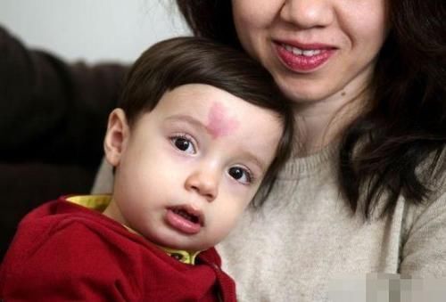 营养不良|宝宝为什么会长胎记?医生:孕期3种行为或易长胎记,建议了解