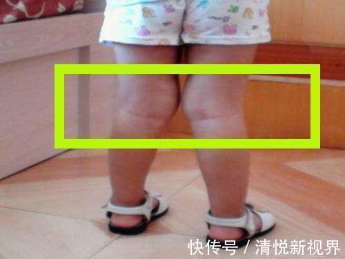 腿部|3岁儿子腿部畸形,只因妈妈的小动作,很多家长还不自知
