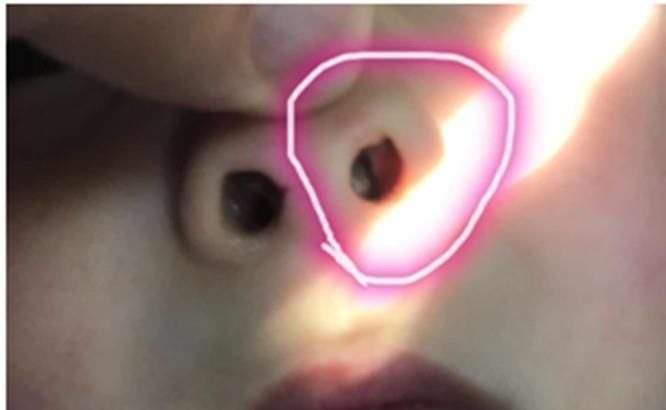 宝妈|3岁女孩散发恶臭,宝妈慌忙就医,医生发现问题出在鼻子里