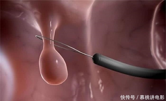 好坏|息肉有好坏之分,这2个部位出现息肉,赶紧上医院吧!