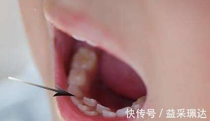 不良习惯|吃的太“好”了医院每天接诊20多个双排牙孩子,家长别再这样喂了