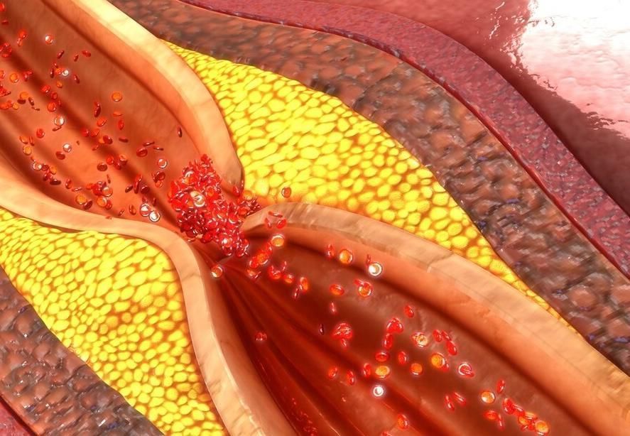 血脂|每天吃洋葱可以降血脂？协和教授：真正的降血脂的是2件事