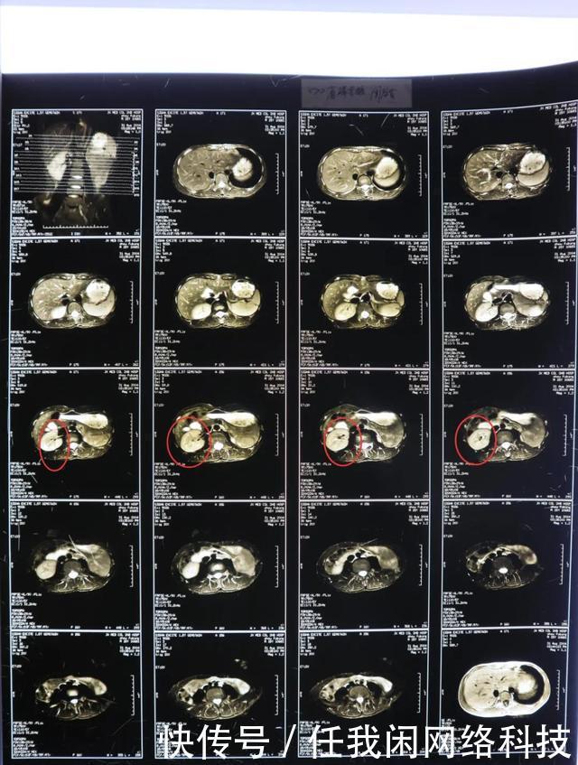 17年前的一场手术后,肾不见了