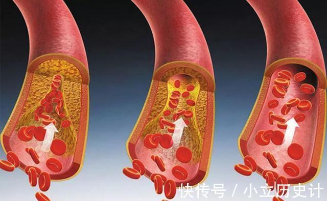原发性|血脂偏高，身体或会有2个表现，建议引起重视，别后知后觉