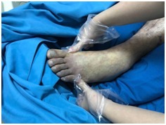 呼吸机|身上爬满红色蛛网，气道壁长出黑色锈斑，33岁的他遭遇生死劫，死里逃生