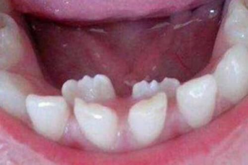 换牙期|7岁男孩长“双排牙”,原因是妈妈的精细喂养,换牙期宝宝要注意