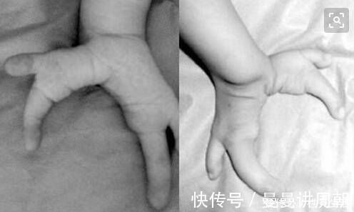 电磁波|胎儿“龙虾手”因辐射导致生活中这些电器辐射对胎儿有影响吗?