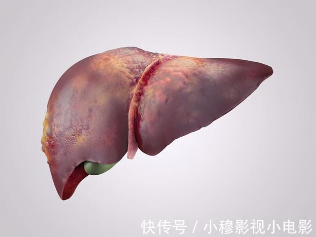 癌细胞|从肝炎恶化成肝癌,一般要多久?常感觉乏力,体重变轻,该检查了