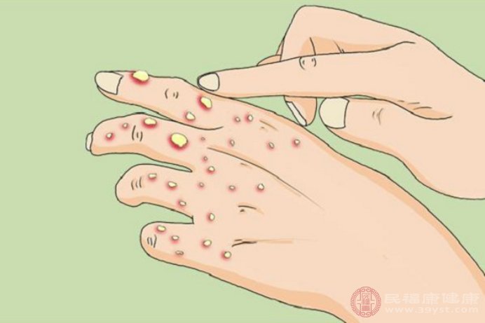 手背上起小疙瘩怎么办