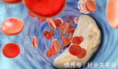 高血脂|为什么高血脂越来越多？医生直言：和肥肉无关，3种素食才是祸根