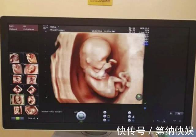 孕妈|做四维彩超时,为什么胎儿总是不露脸