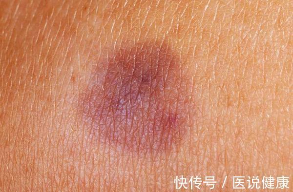 螺旋体|莱姆病的病程有快有慢,发现这5种情况,及时检查,切莫耽误病情