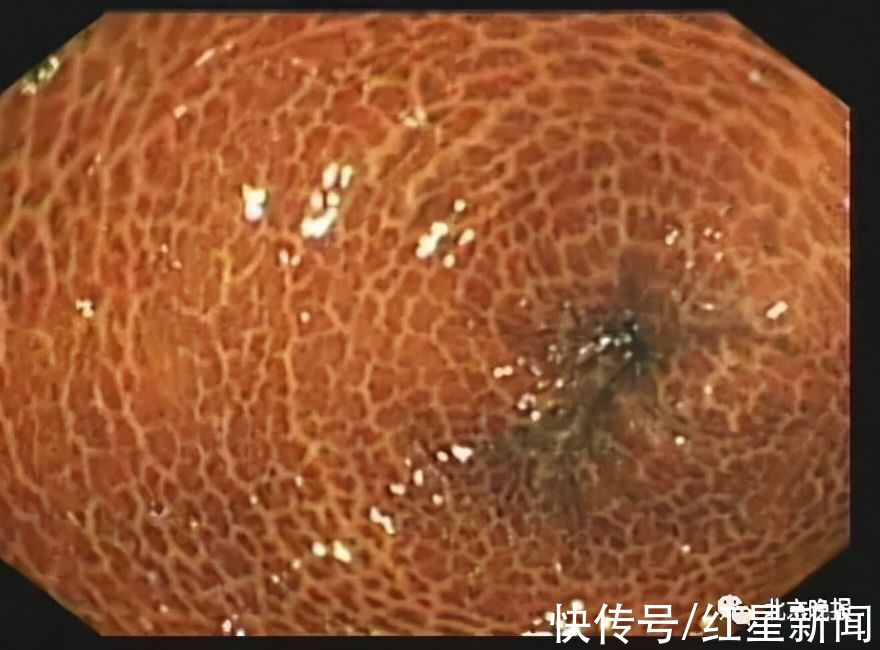 结肠黑变病|豹纹?蛇皮?她吃了3年这种“药”,肠子表面变成…