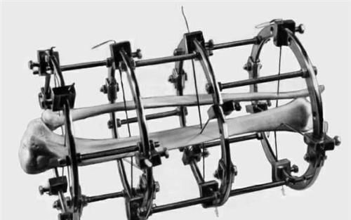 手术|为了长高7.2厘米,花16万做断骨手术的少年李亚诺,如今彻夜难眠