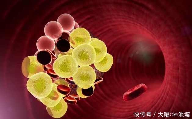 做好|血栓不是一天形成的,警惕四种表现,补3黄,做好4字,抵住血栓