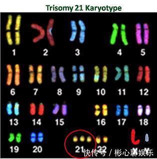 智力|每20分钟就有1位唐氏儿出生,孕妇该如何避免生出智力低的唐宝